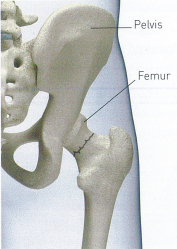 Stable fracture